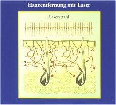 Laserhaarentfernung