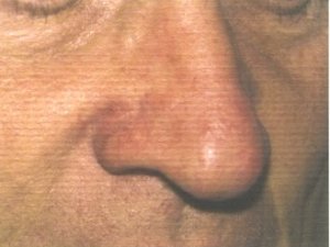 papillom2